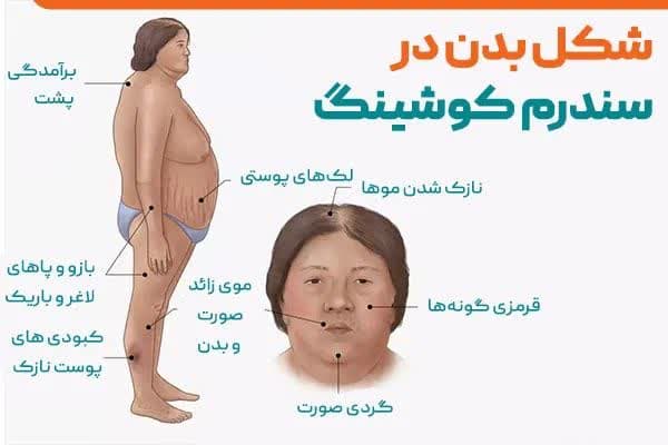 سندرم کوشینگ چیست ؟ علت و علائم و درمان سندرم کوشینگ