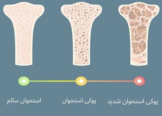 استئوپروز چیست ؟