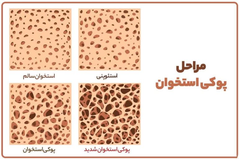 مراحل پوکی استخوان چیست ؟