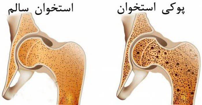 تعریف استئوپروز