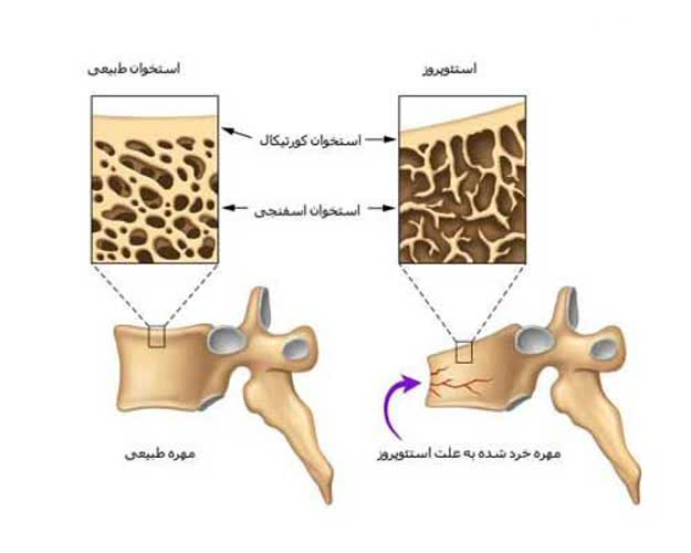 تعاریف استئوپروز